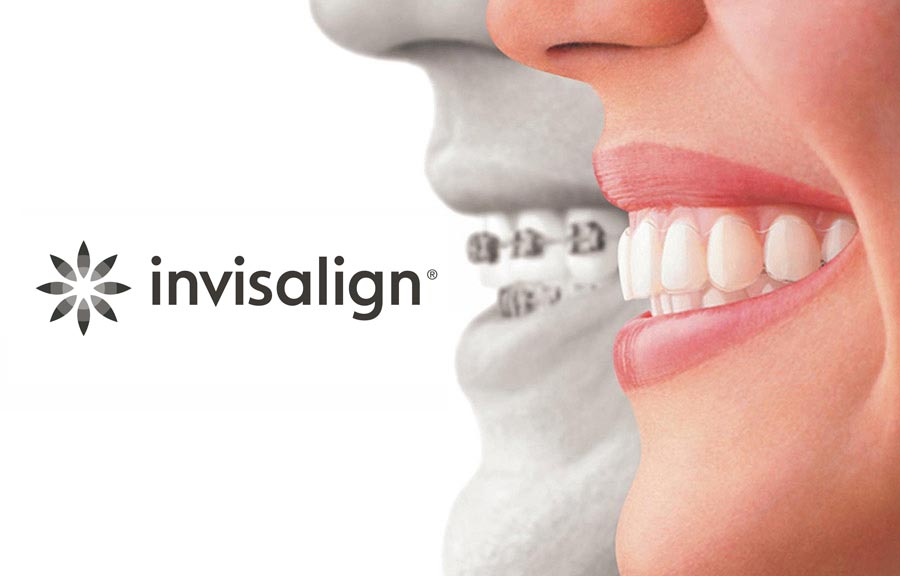 Invisalign.