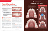 Palatal Expanders - Dear Doctor Magazine