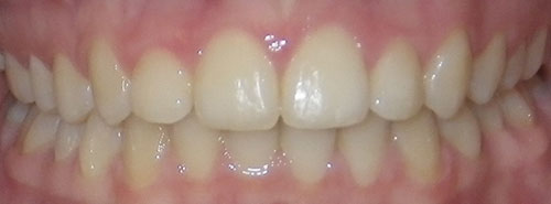 Post treatment Smile of a preteen patient with an underbite