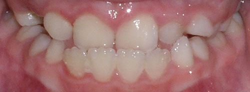 Pre treatment Smile of a preteen patient with an underbite