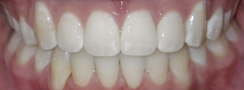 Post treatment smile of preteen with crowding