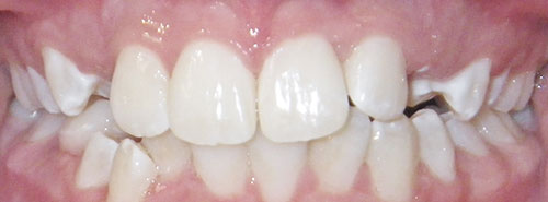 Pre treatment smile of preteen with crowding