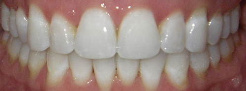 Post treatment Smile of adult female Invisalign patient before treatment