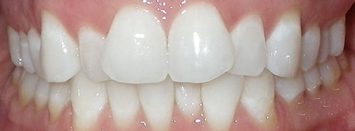 Pre treatment Smile of adult female Invisalign patient before treatment