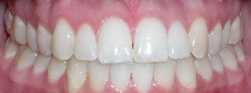 Post treatment Smile of patient with narrow upper jaw