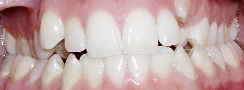 Pre treatment Smile of patient with narrow upper jaw