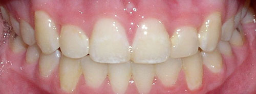 Post treatment smile of female patient with severe crowding