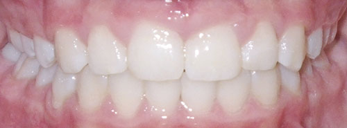 Post treatment smile of a preteen patient with a deep bite