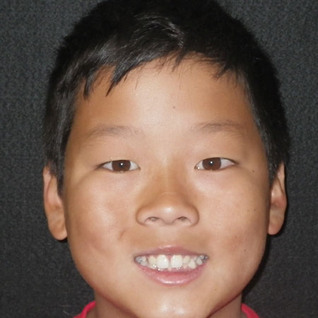 Pre treatment preteen patient with diastema