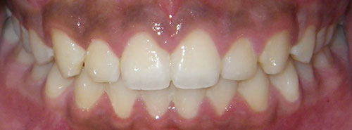 Post treatment smile of preteen boy with a diastema