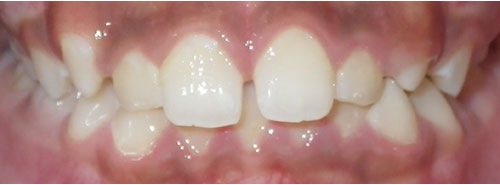 Pre treatment smile of preteen boy with a diastema