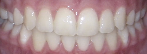 Post treatment smile of teen girl with blocked out canines