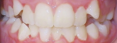 Pre treatment smile of teen girl with blocked out canines