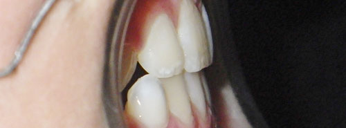 Post treatment profile of patient with underbite