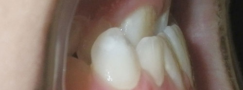 Pre treatment profile of patient with underbite