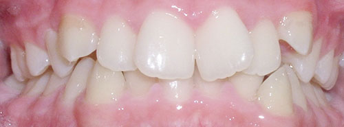 Pre treatment smile of teen patient with crowding