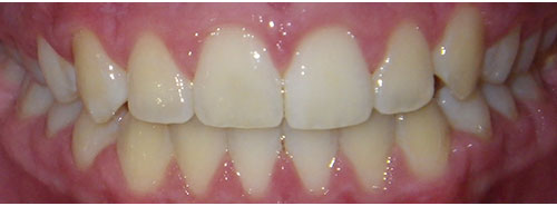 Post treatment smile of a patient with an openbite due to tongue thrust