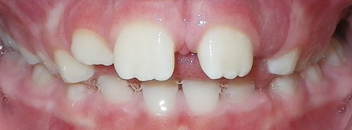 Post treatment smile of a patient with an openbite due to tongue thrust