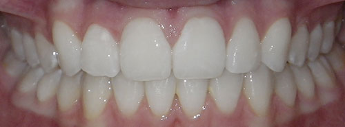 Post treatment Smile of teen female Invisalign patient before treatment