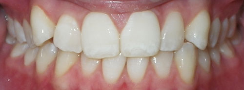 Pre treatment Smile of teen female Invisalign patient before treatment