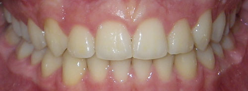 Post treatment Smile of Male teen Invisalign patient before treatment