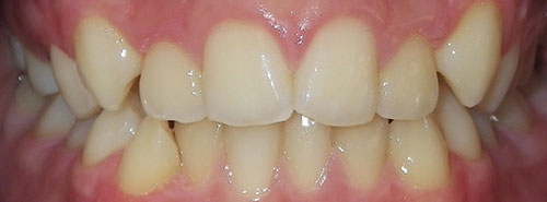 Pre treatment Smile of Male teen Invisalign patient before treatment