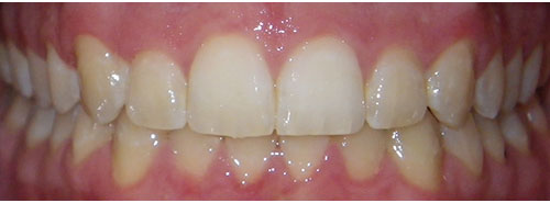 Post treatment Smile of adult male Invisalign patient before treatment