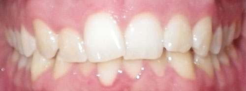 Pre treatment Smile of adult male Invisalign patient before treatment