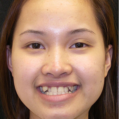 Pre treatment Adult patient with underbite and crowding