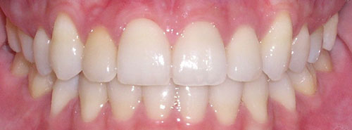 post treatment smile of patient with underbite and crowding