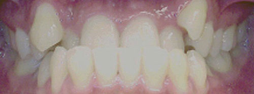 Pre treatment smile of patient with underbite and crowding