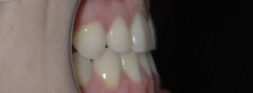 Post treatment profile of patient underbite