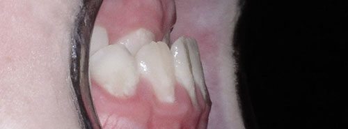 Pre treatment profile of patient underbite