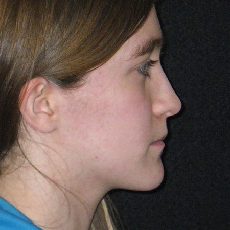 Post treatment profile of patient underbite