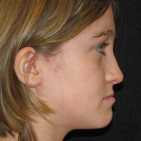 Pre treatment profile of patient underbite