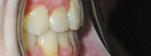 Post treatment profile of patient underbite