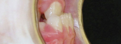 Pre treatment profile of patient underbite