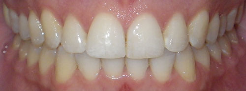 Post treatment Smile of Adult female Invisalign patient before treatment