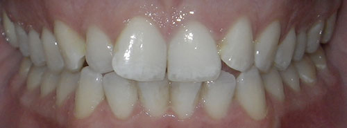 Pre treatment Smile of Adult female Invisalign patient before treatment