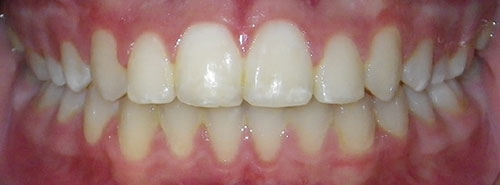 post treatment of a smile with a functional shift