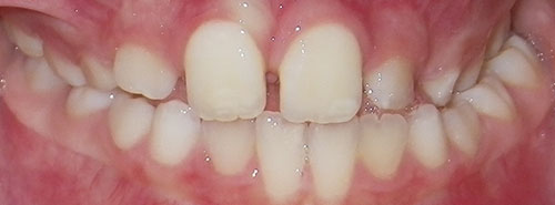 pre treatment of a smile with a functional shift