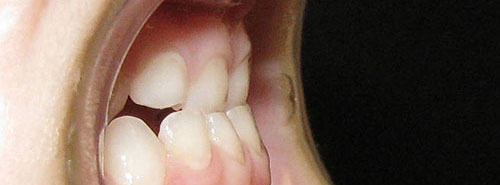 Pre treatment profile of patient underbite