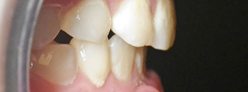 Post treatment profile of patient underbite