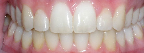 Post treatment smile of teen girl with large overjet