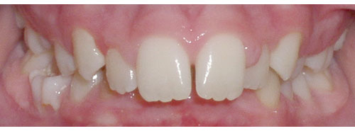 Pre treatment smile of teen girl with large overjet