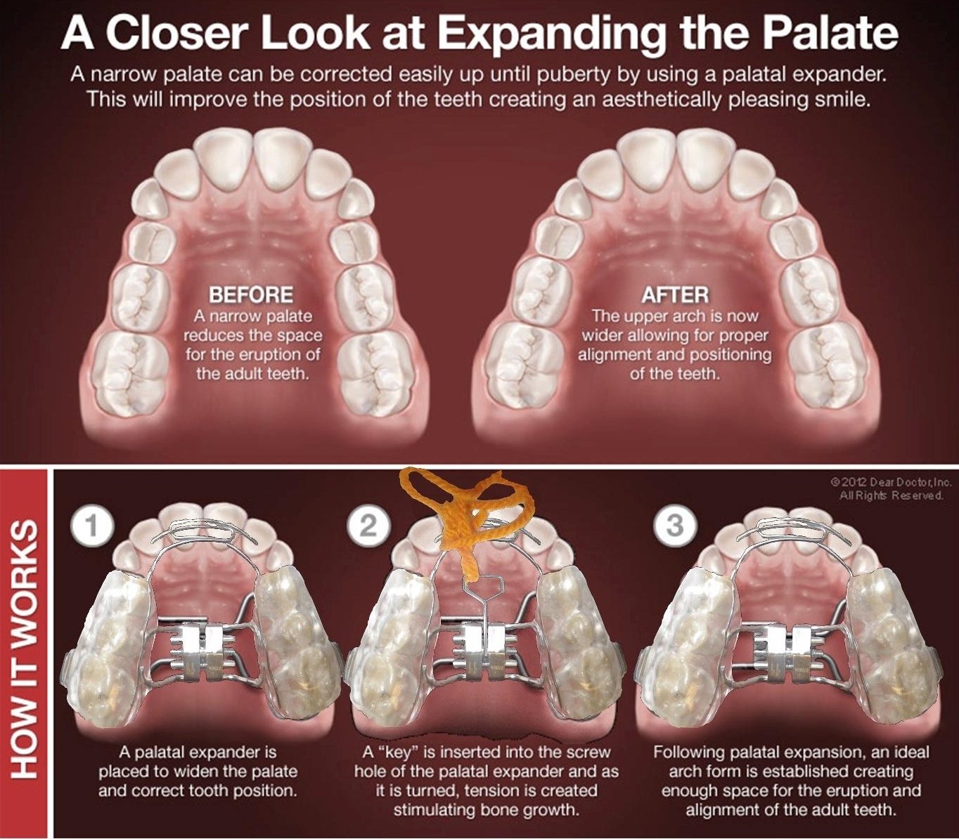 Hyrax 1 palatal expander