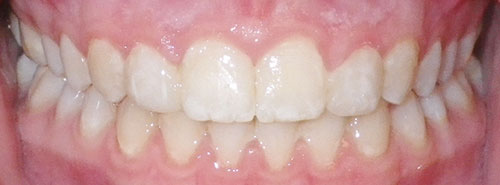 post treatment smile of patient with excess spaces