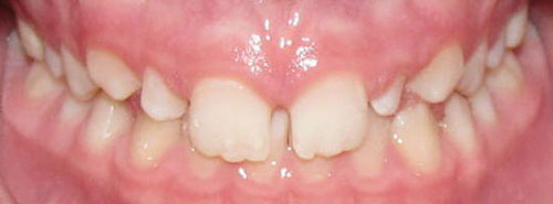 Pre treatment smile of patient with excess spaces