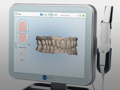 Digital Impressions at Evans Orthodontics in Rapid, City, SD.